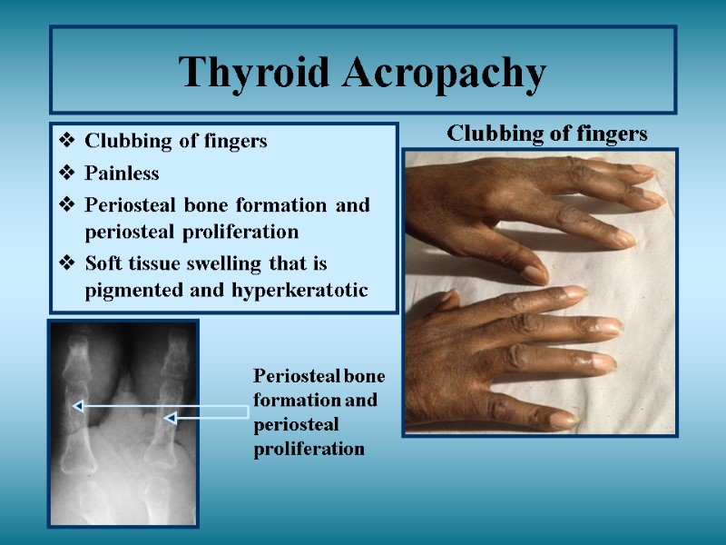 Thyroid Acropachy Clubbing of fingers Painless Periosteal bone formation and periosteal proliferation  Soft